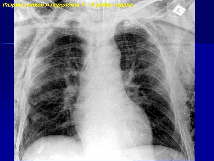 Разрыв трахеи и переломы 7 – 9 ребер справа 