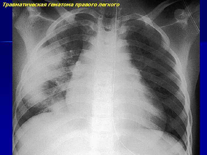 Травматическая гематома правого легкого 