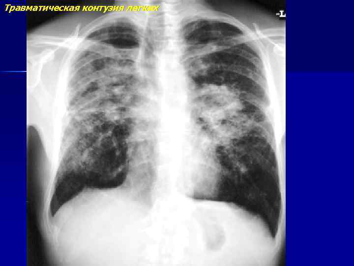 Травматическая контузия легких 