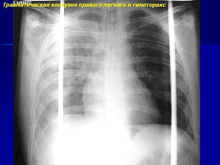 Травматическая контузия правого легкого и гемоторакс 