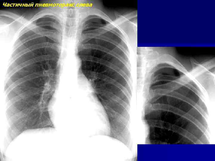 Частичный пневмоторакс слева 