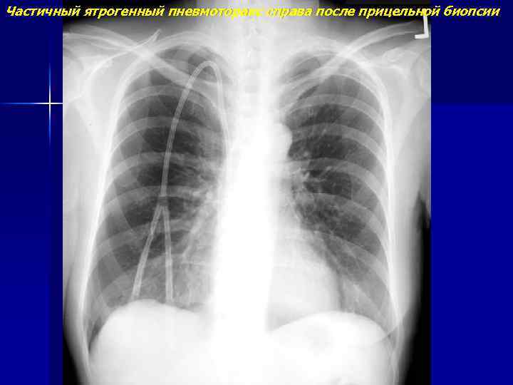 Частичный ятрогенный пневмоторакс справа после прицельной биопсии 