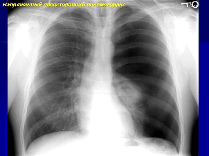 Напряженный левосторонний пневмоторакс 