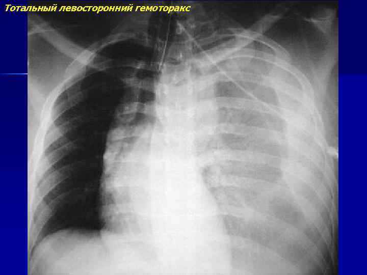 Тотальный левосторонний гемоторакс 