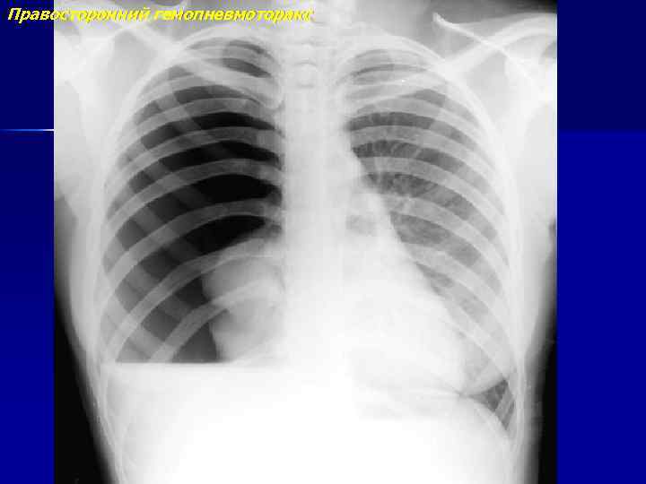 Правосторонний гемопневмоторакс 