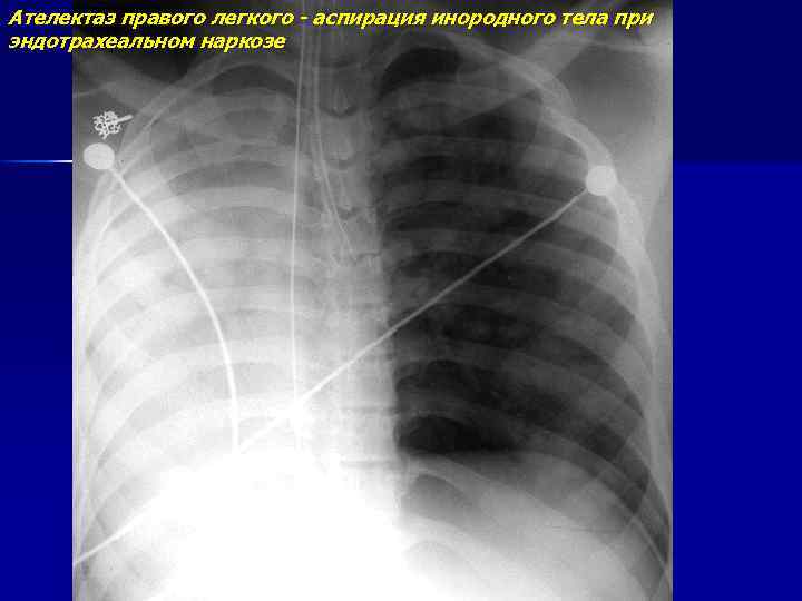 Ателектаз правого легкого - аспирация инородного тела при эндотрахеальном наркозе 