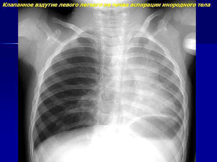 Клапанное вздутие левого легкого на почве аспирации инородного тела 