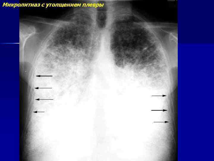 Микролитиаз с утолщением плевры 