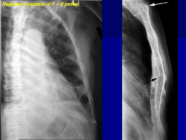 Перелом грудины и 7 – 8 ребер 