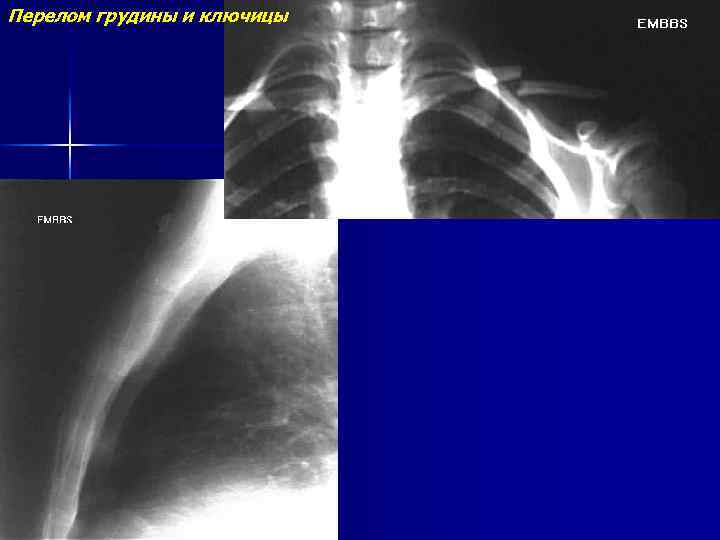 Перелом грудины и ключицы 