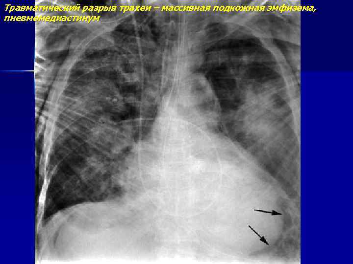 Травматический разрыв трахеи – массивная подкожная эмфизема, пневмомедиастинум 