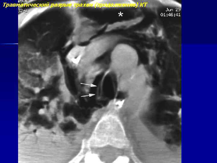 Травматический разрыв трахеи (продолжение) КТ 