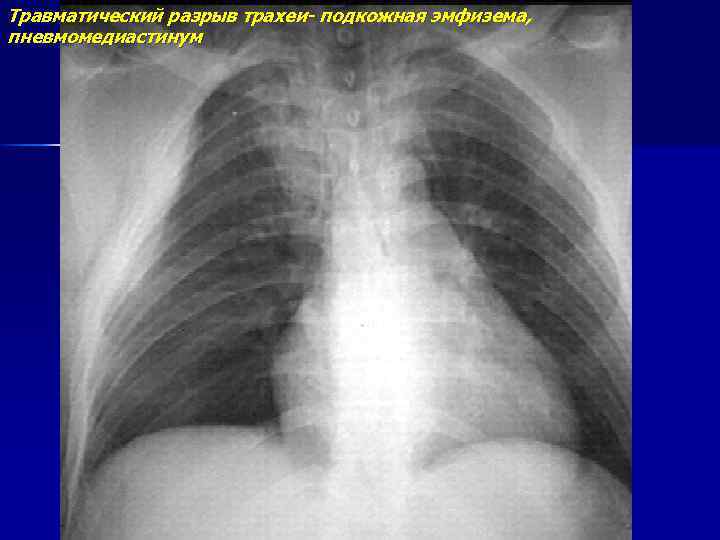 Травматический разрыв трахеи- подкожная эмфизема, пневмомедиастинум 