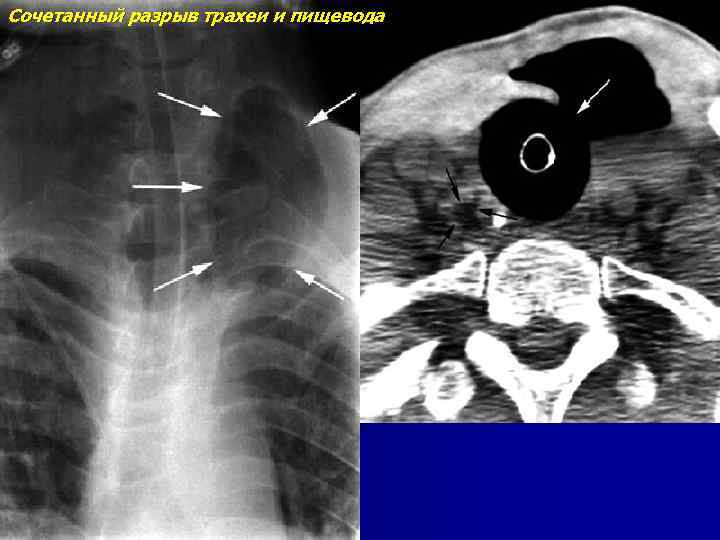 Сочетанный разрыв трахеи и пищевода 