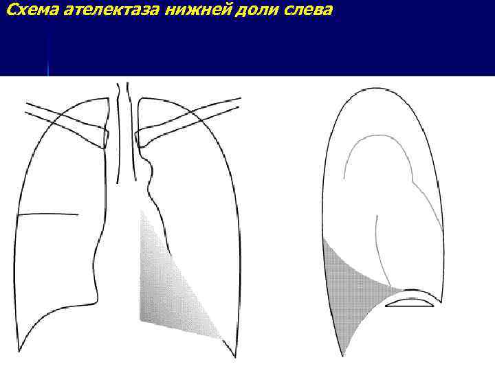 Ателектазы рентген схема