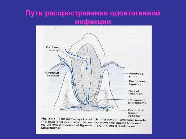 Пути распространения одонтогенной инфекции 