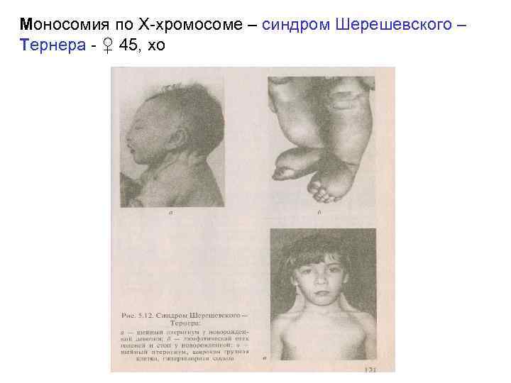 Моносомия по Х-хромосоме – синдром Шерешевского – Тернера - ♀ 45, хо 