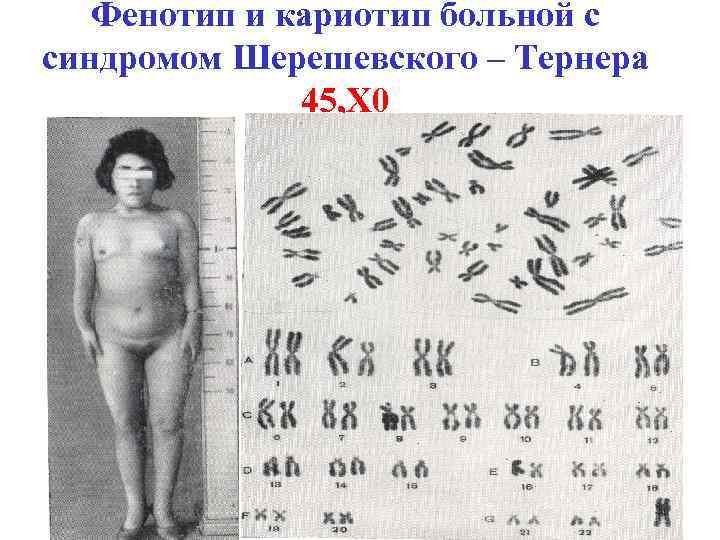 Фенотип и кариотип больной с синдромом Шерешевского – Тернера 45, Х 0 