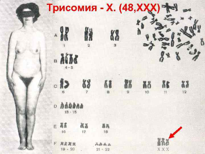 Трисомия - Х. (48, ХХХ) 
