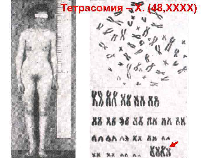 Тетрасомия – Х. (48, ХХХХ) 
