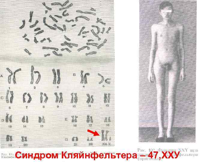 Синдром Кляйнфельтера – 47, ХХУ 