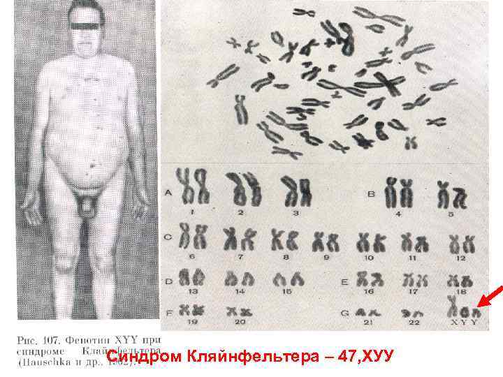 Синдром Кляйнфельтера – 47, ХУУ 