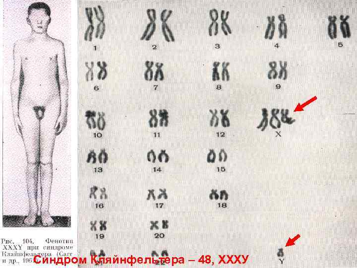 Синдром Кляйнфельтера – 48, ХХХУ 