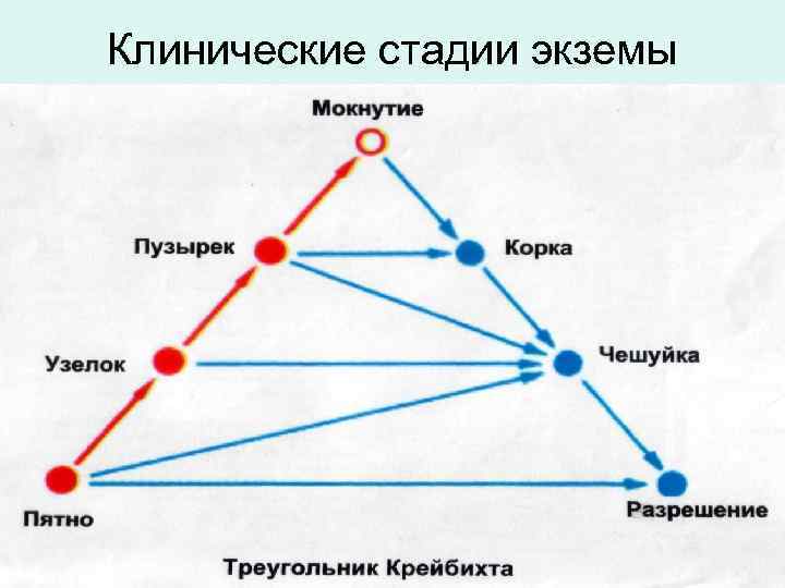 Клинические стадии экземы 