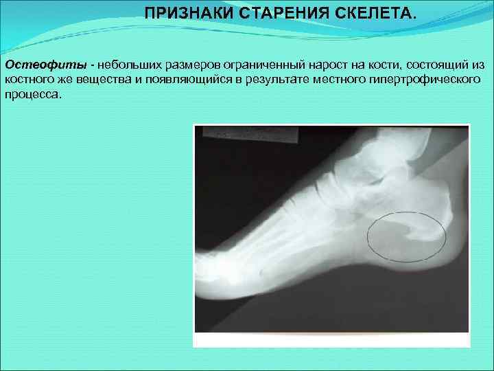 ПРИЗНАКИ СТАРЕНИЯ СКЕЛЕТА. Остеофиты - небольших размеров ограниченный нарост на кости, состоящий из костного