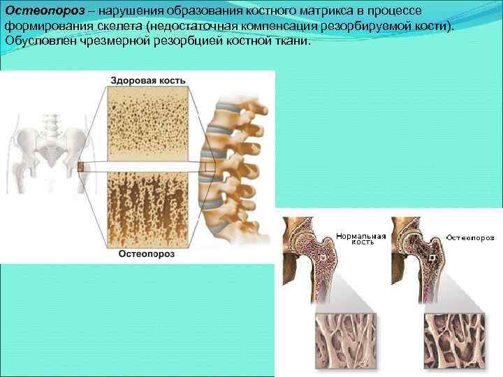 Остеопороз – нарушения образования костного матрикса в процессе формирования скелета (недостаточная компенсация резорбируемой кости).