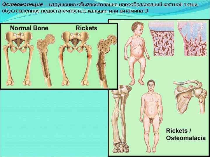 Остеомаляция – нарушение обызвествления новообразований костной ткани, обусловленное недостаточностью кальция или витамина D. 