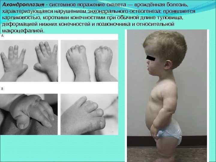 Ахондроплазия - системное поражение скелета — врождённая болезнь, характеризующаяся нарушением энхондрального остеогенеза; проявляется карликовостью,