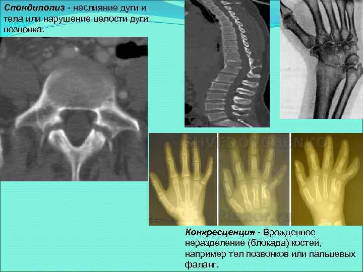 Спондилолиз - неслияние дуги и тела или нарушение целости дуги позвонка. Конкресценция - Врожденное