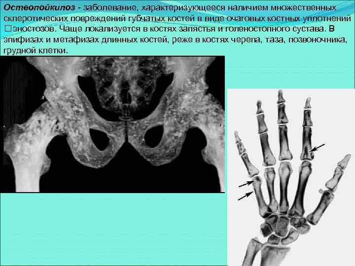 Остеопойкилоз - заболевание, характеризующееся наличием множественных склеротических повреждений губчатых костей в виде очаговых костных