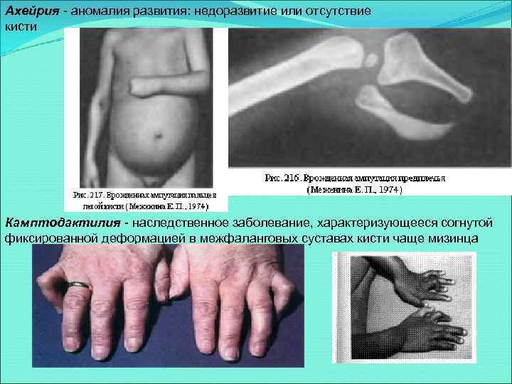 Ахейрия - аномалия развития: недоразвитие или отсутствие кисти Камптодактилия - наследственное заболевание, характеризующееся согнутой