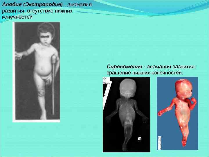 Аподия (Экстроподия) - аномалия развития: отсутствие нижних конечностей Сиреномелия - аномалия развития: сращение нижних