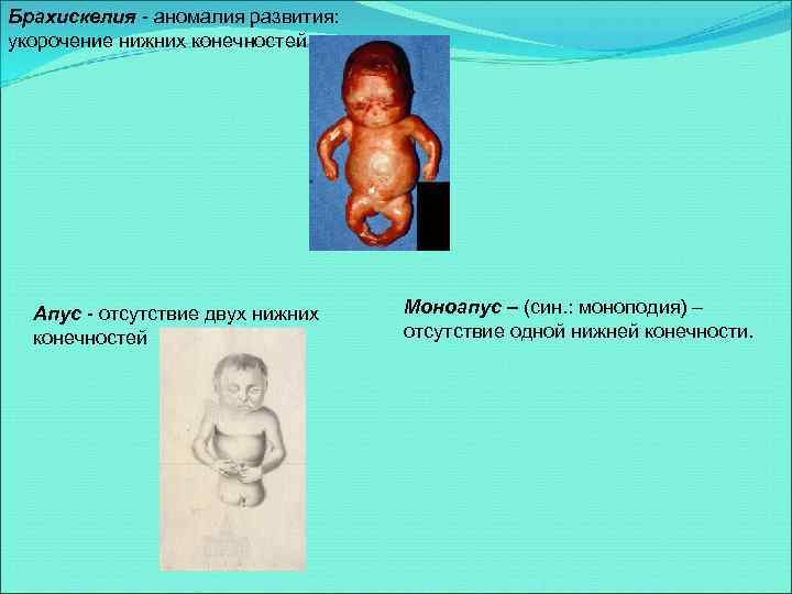 Брахискелия - аномалия развития: укорочение нижних конечностей. Апус - отсутствие двух нижних конечностей Моноапус