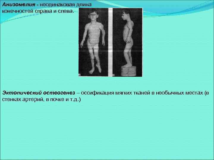 Анизомелия - неодинаковая длина конечностей справа и слева. Эктопический остеогенез – оссификация мягких тканей