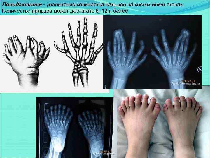 Полидактилия - увеличение количества пальцев на кистях или/и стопах. Количество пальцев может достигать 8,