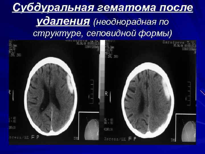 Субдуральная гематома. Пластинчатая субдуральная гематома кт. Пластинчатая субдуральная гематома головного мозга. Субдуральная эмпиема кт. Пластинчатая субдуральная гематома слева.