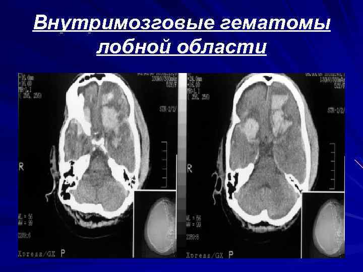 Гематома орбитальной области карта вызова