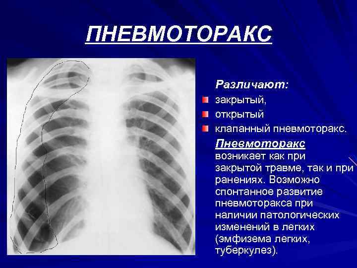 Презентация пневмоторакс и гемоторакс