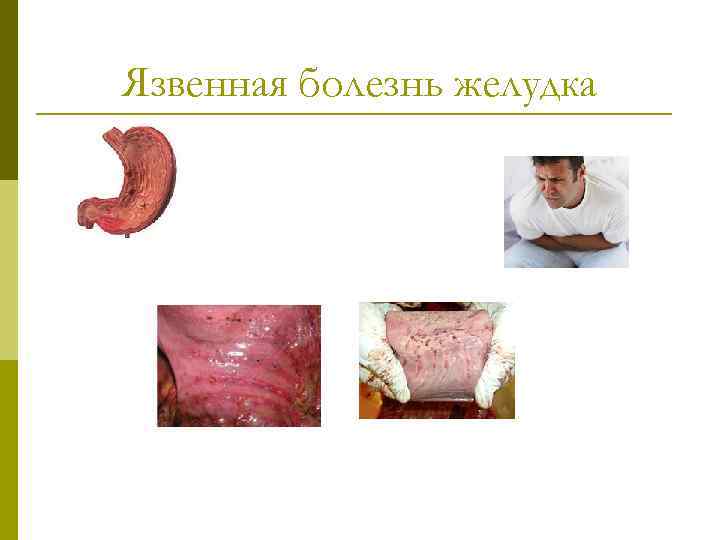 Язвенная болезнь желудка 