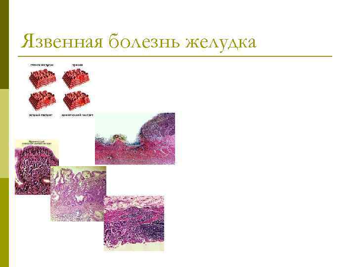 Язвенная болезнь желудка 