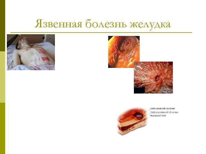 Язвенная болезнь желудка 