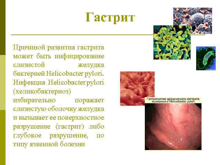Гастрит Причиной развития гастрита может быть инфицирование слизистой желудка бактерией Helicobacter pylori. Инфекция Helicobacter