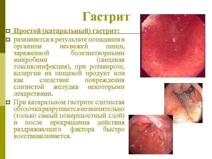 Гастрит p p p Простой (катаральный) гастрит: развивается в результате попадания в организм несвежей