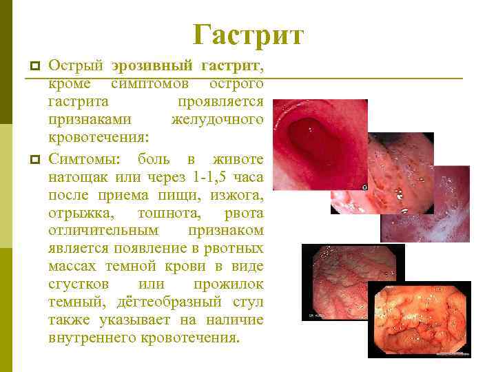Гастрит p p Острый эрозивный гастрит, кроме симптомов острого гастрита проявляется признаками желудочного кровотечения: