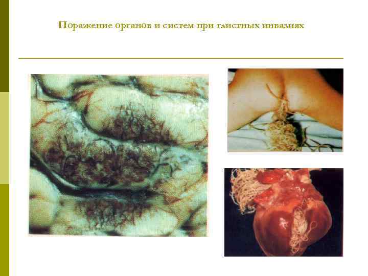 Поражение органов и систем при глистных инвазиях 