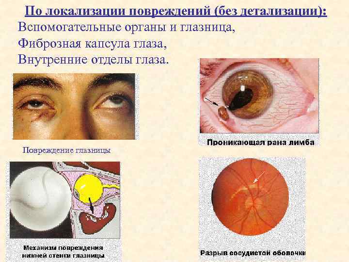 По локализации повреждений (без детализации): Вспомогательные органы и глазница, Фиброзная капсула глаза, Внутренние отделы
